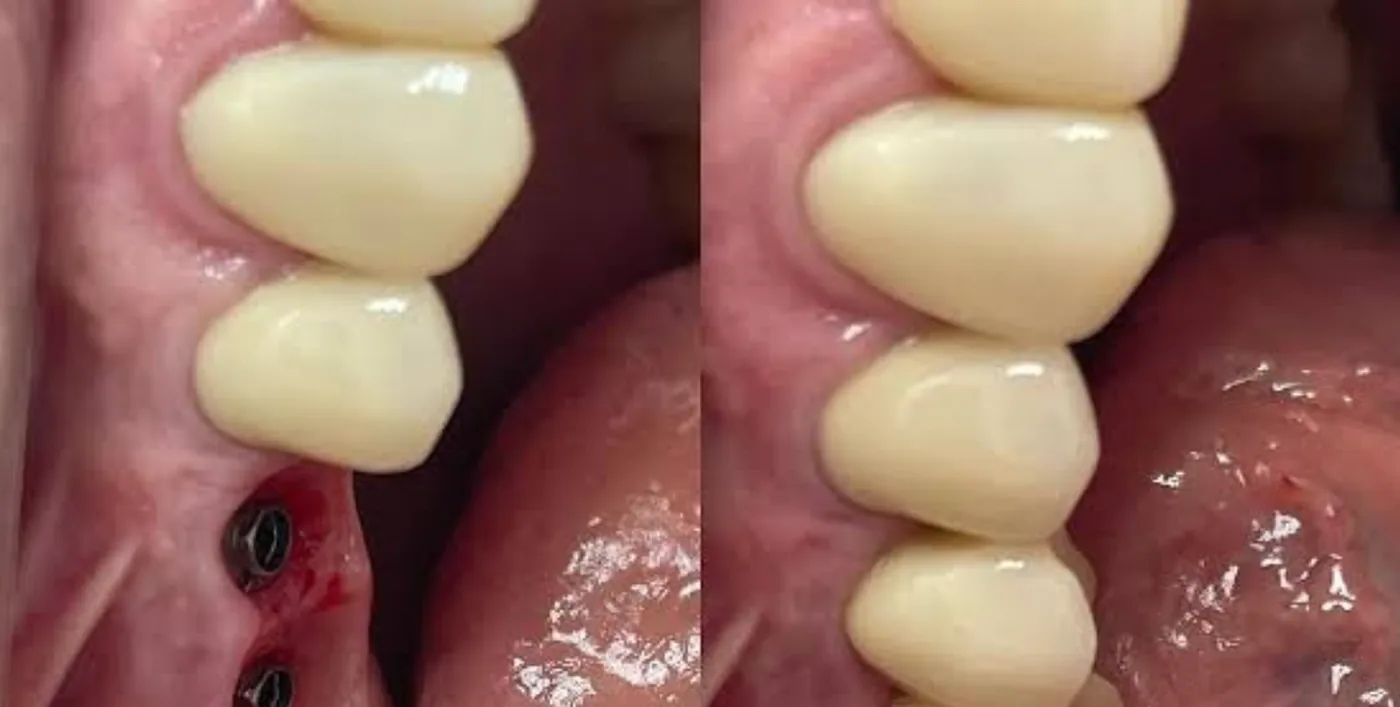 Implantes posteriores + coroas — antes