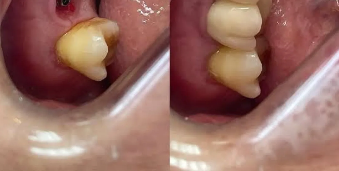 Implantes posteriores + coroas — depois