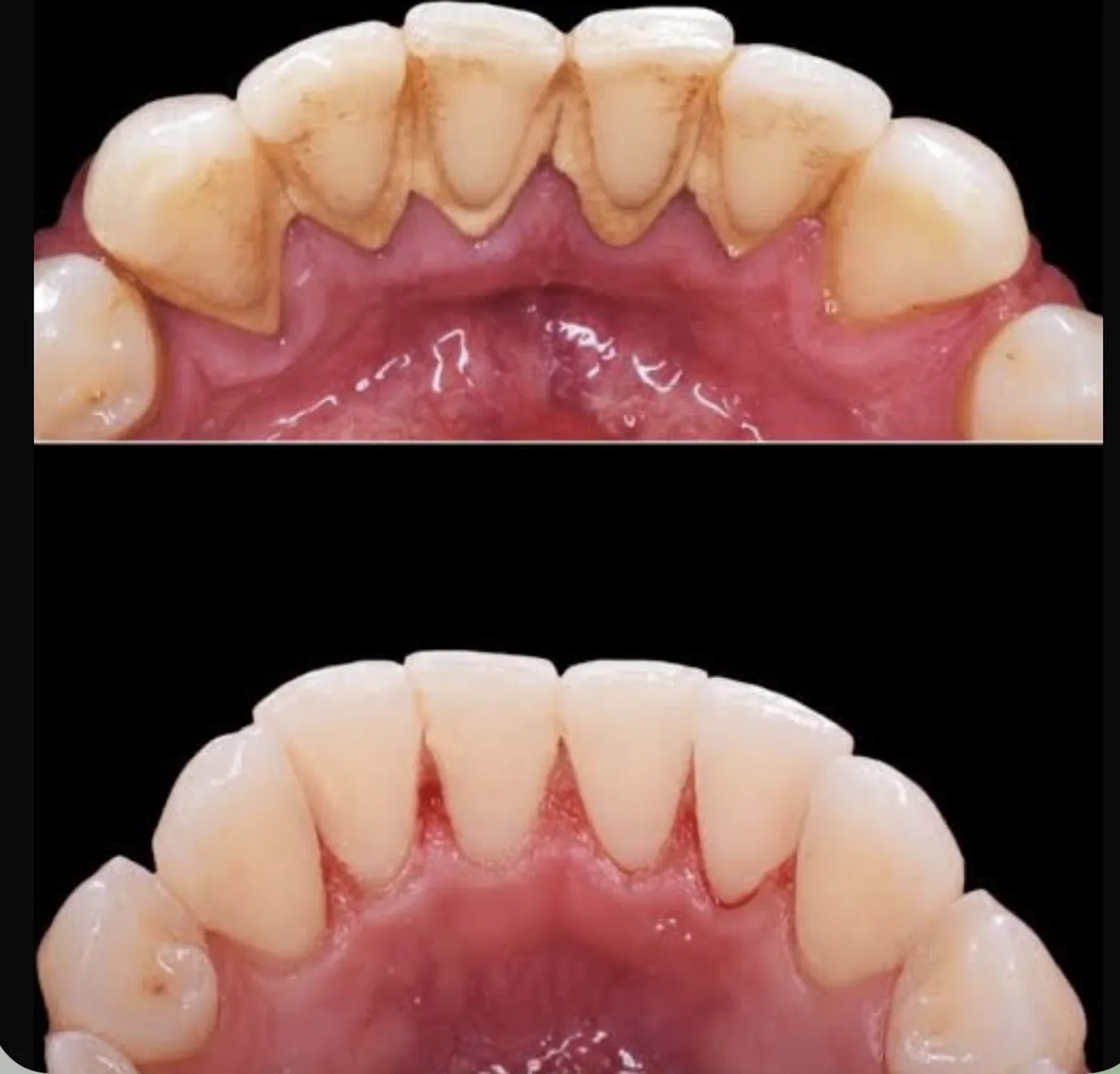 Limpeza dental · antes e depois