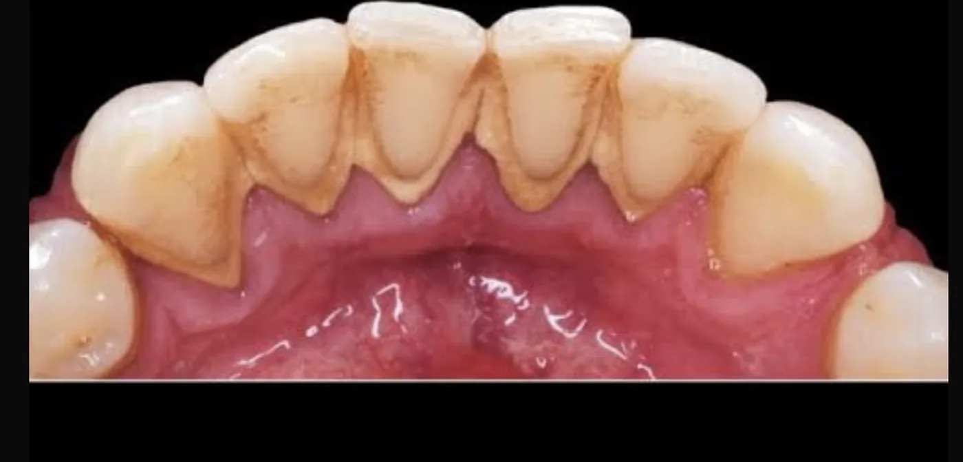 Limpeza dental profissional — antes