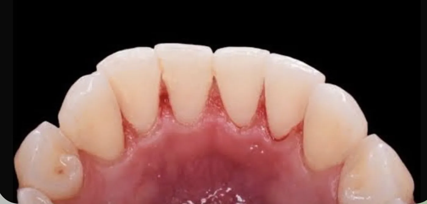 Limpeza dental profissional — depois