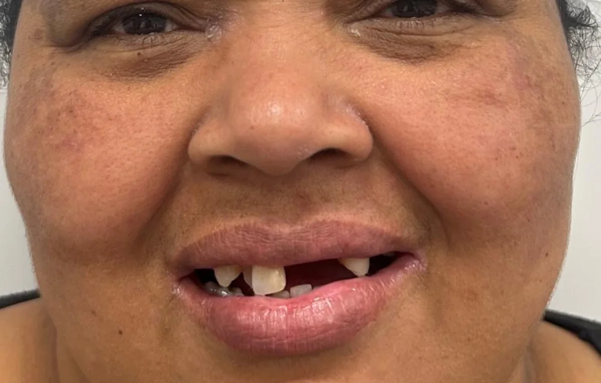 Protocolo · sorriso completo — antes