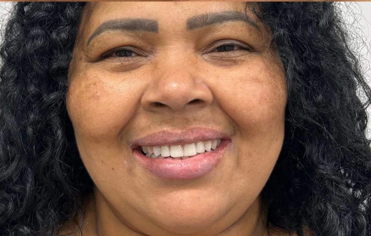 Protocolo · sorriso completo — depois