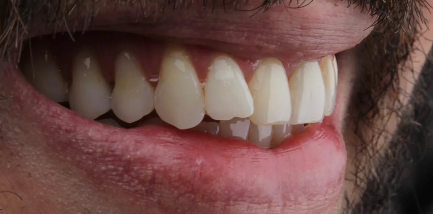 Facetas · reabilitação estética — antes