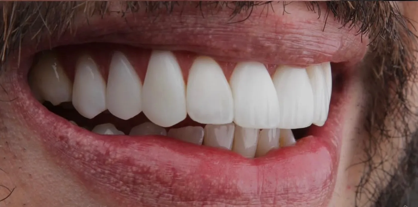 Facetas · reabilitação estética — depois